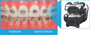damon-braces-comparison